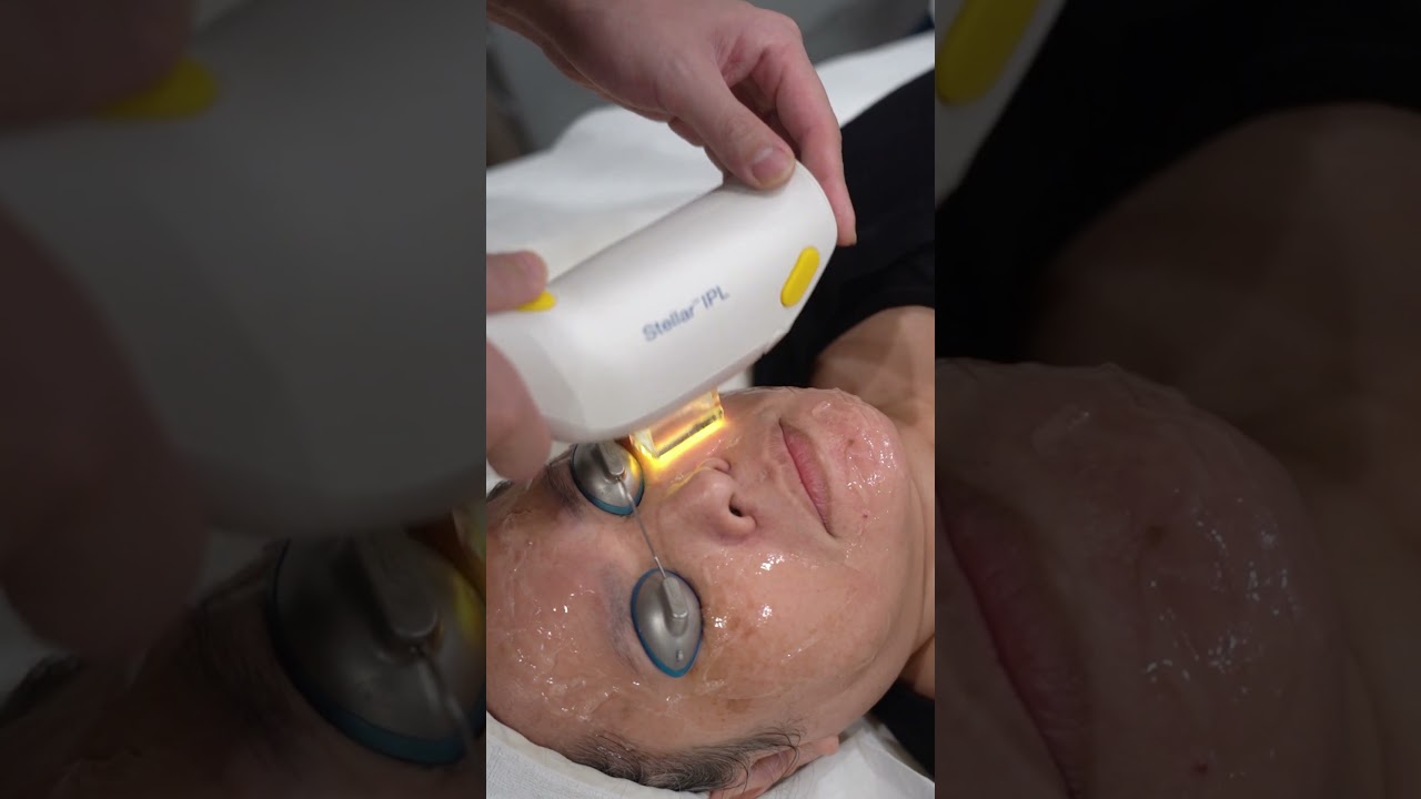 Tired of those stubborn dark spots telling your skin’s past?  The Stellar M22 is here! #darkspots