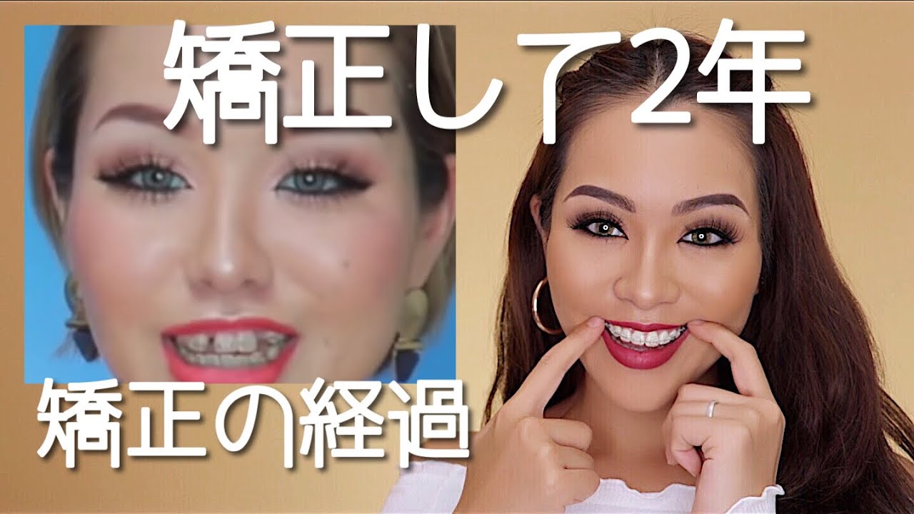 矯正して2年経過！セラミックってどうなの？口臭は？矯正質問コーナー！