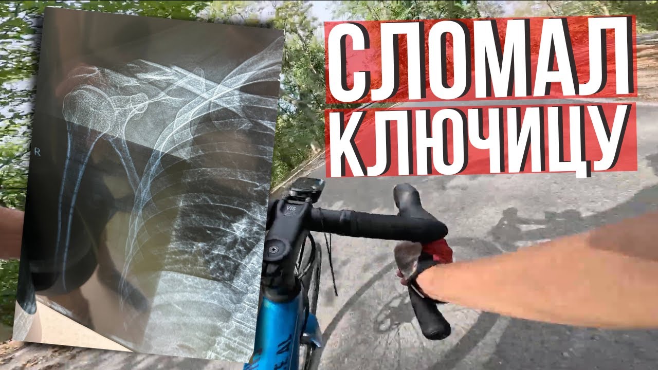 Как я сломал ключицу на велосипеде