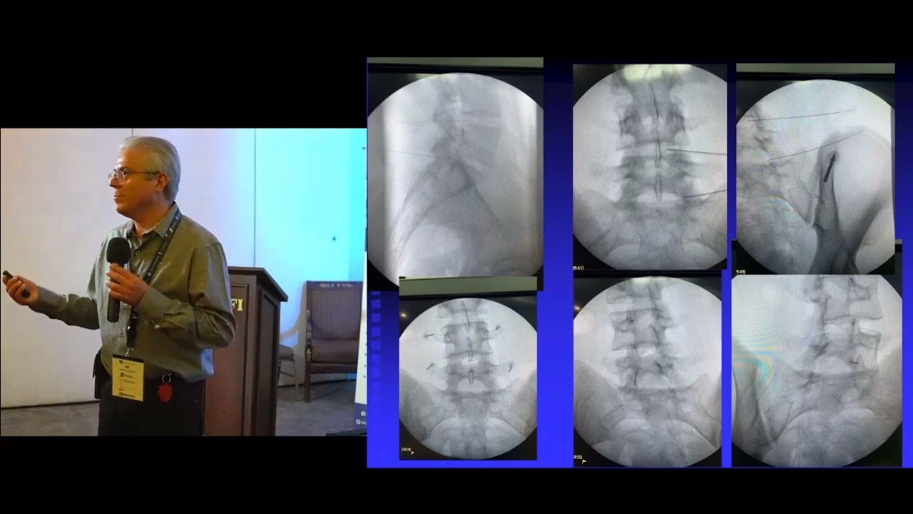 ¿Quién es candidato para Medicina Regenerativa en columna vertebral?