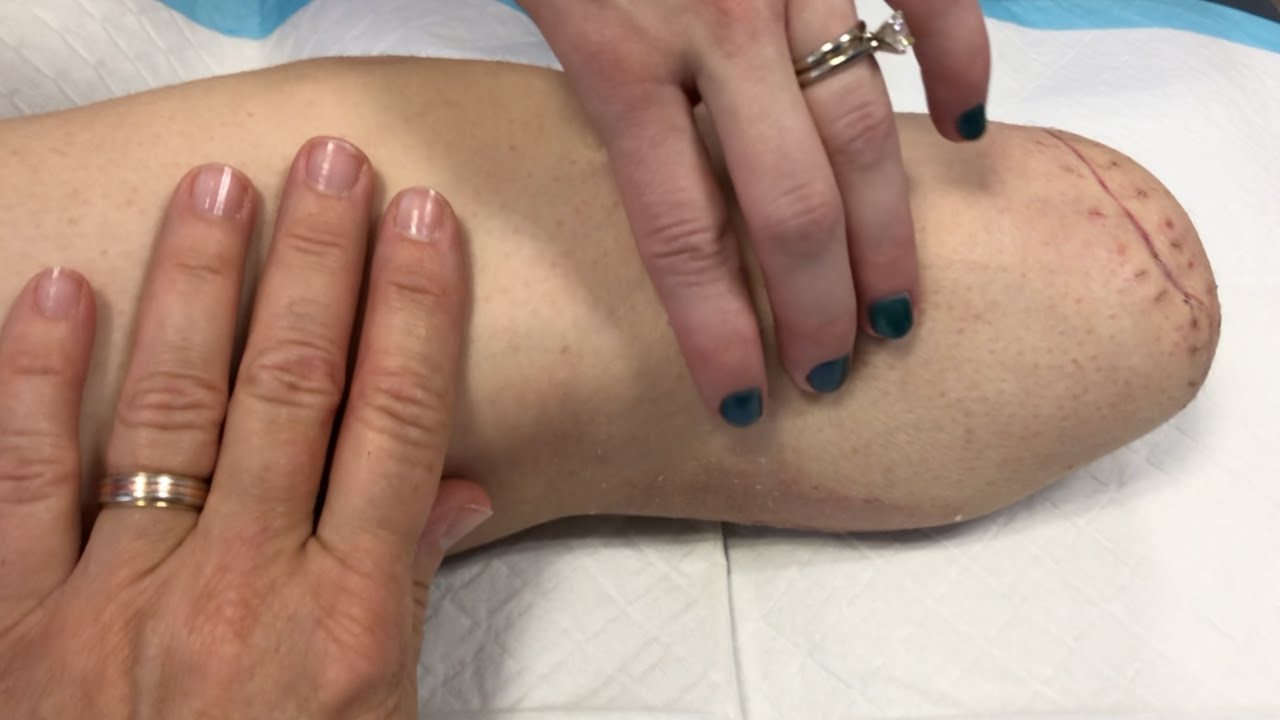 Removing My Cast Off After AMPUTATION! What's Underneath...!?
