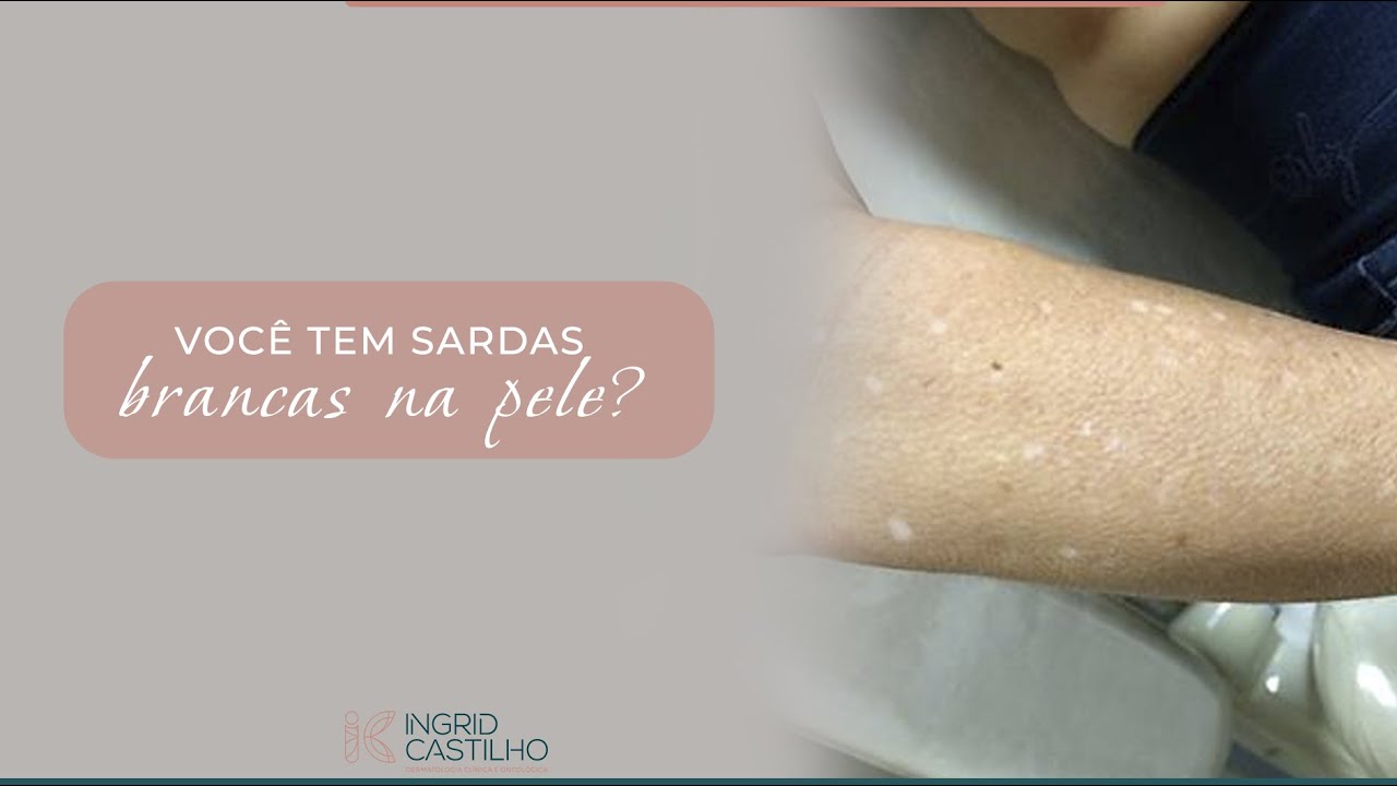 Você tem sardas brancas na pele?