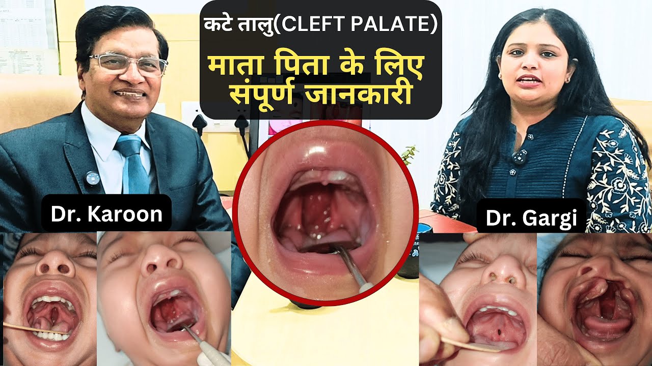 कटे तालु Cleft Palate Podcast with Specialist Dr  Karoon Agrawal