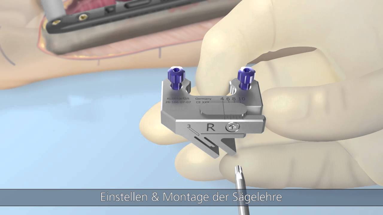 Recos®-Ulnaverkürzung von KLS Martin