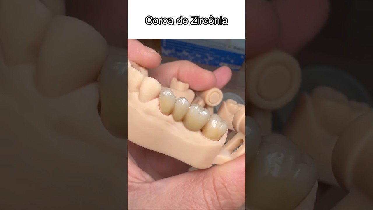 COROA DE ZIRC&Ocirc;NIA #shortsvideo #dentalprosthesis #shortsfeed #dentista#protese#zirconia#oralfeed