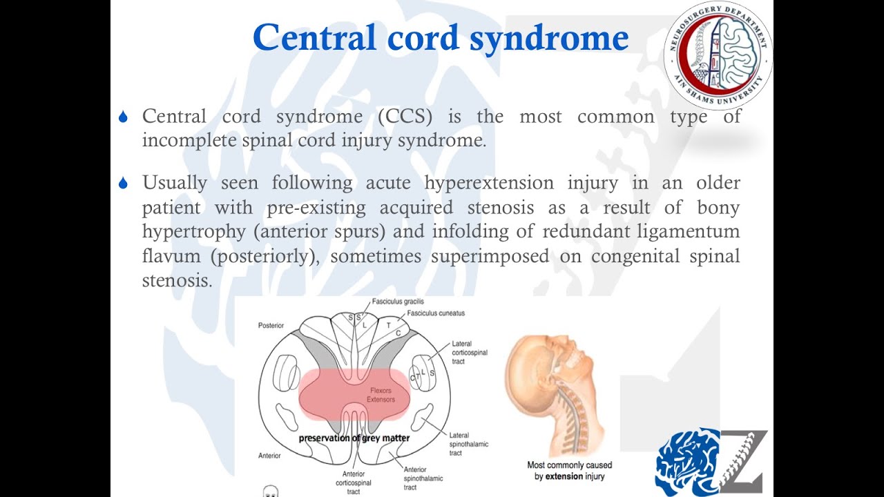 Spinal cord injury (5):  Central Cord Syndrome  اصابات الحبل الشوكي