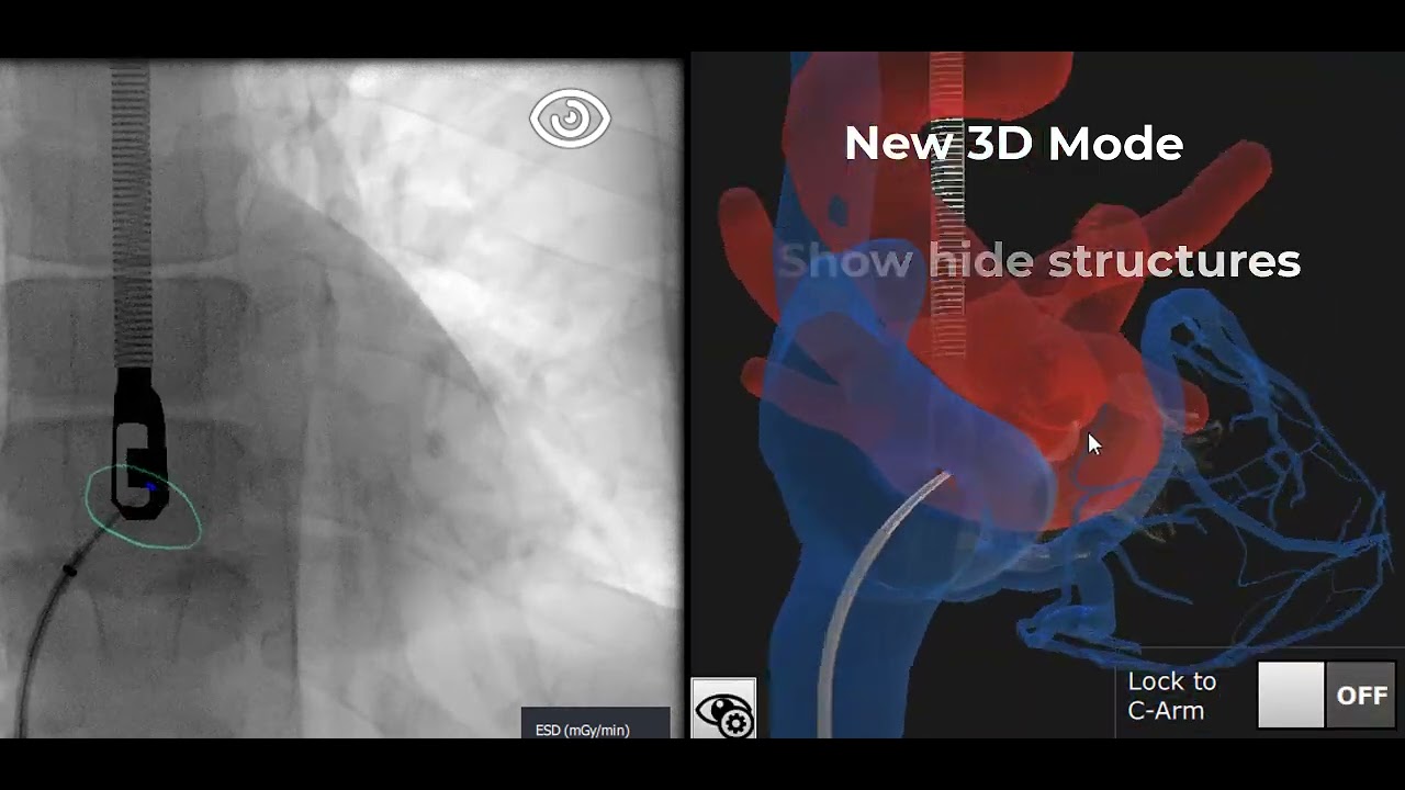 Mentice Transseptal Puncture