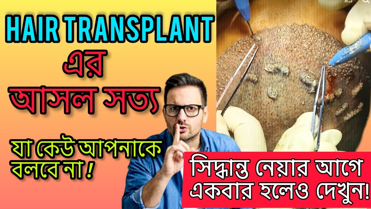 Hair Transplant এর আসল সত্য! যা কেউ বলে না | Hair Transplant BD Result