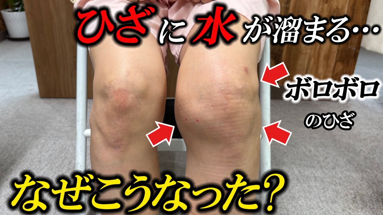 【変形性膝関節症】膝に水が溜まる人これ知らないと一生“注射地獄”…原因は膝じゃなく意外なところに！