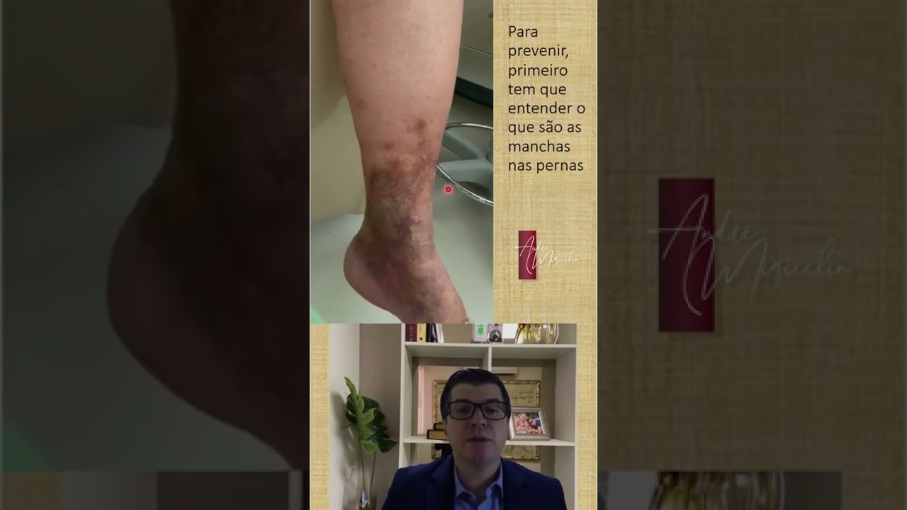 Você sabe qual a melhor forma de prevenir as manchas na perna?
