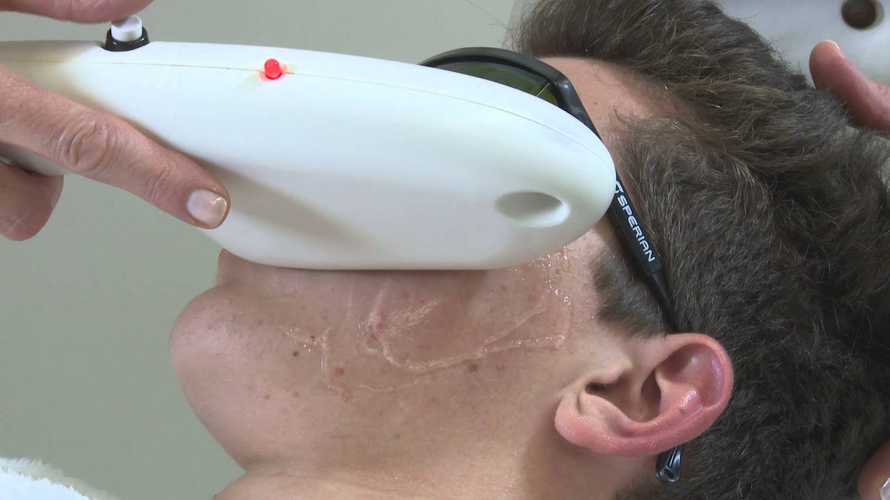 IPL Acne Clearing Treatment BIODROGA MD