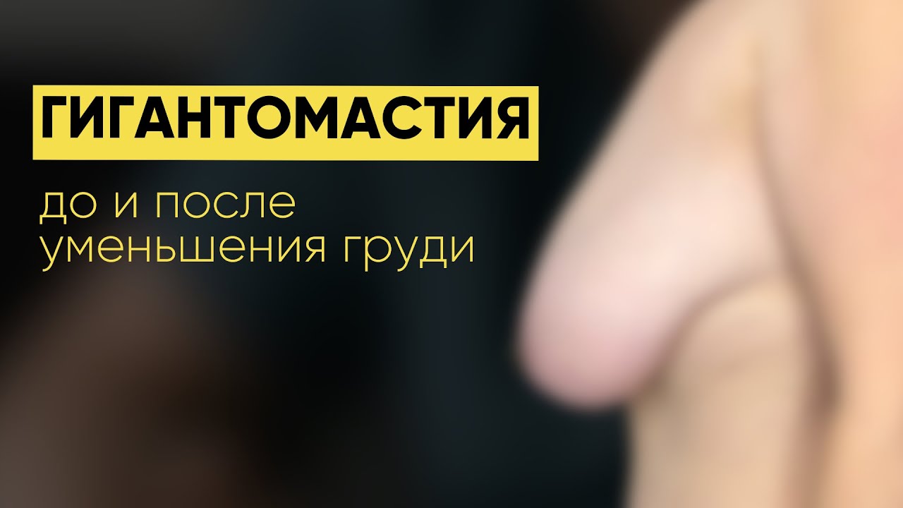 ГРУДЬ МЕШАЛА ЖИТЬ: история пациентки с гигантомастией⬆️