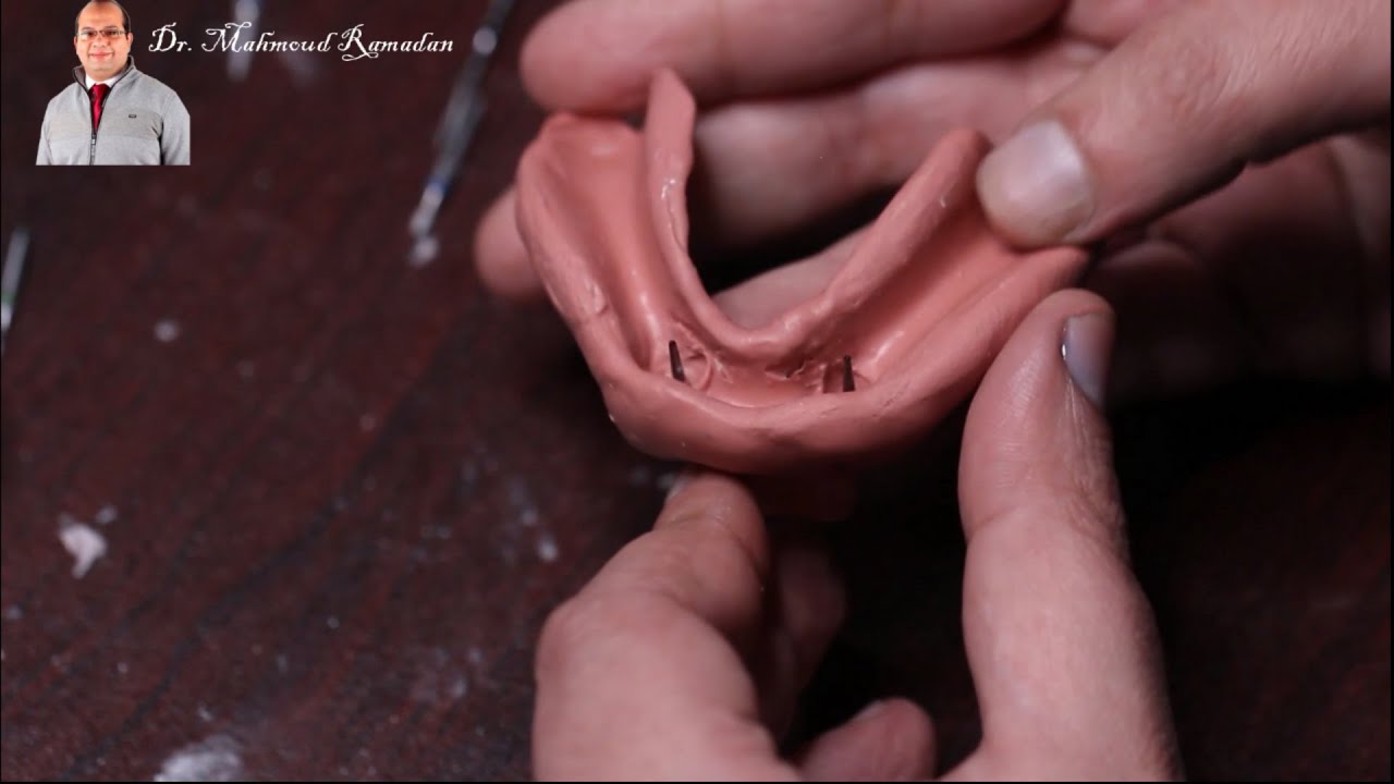Tooth Supported Overdenture. Part 4: Clinical cases, laboratory steps & demo on dummy model.