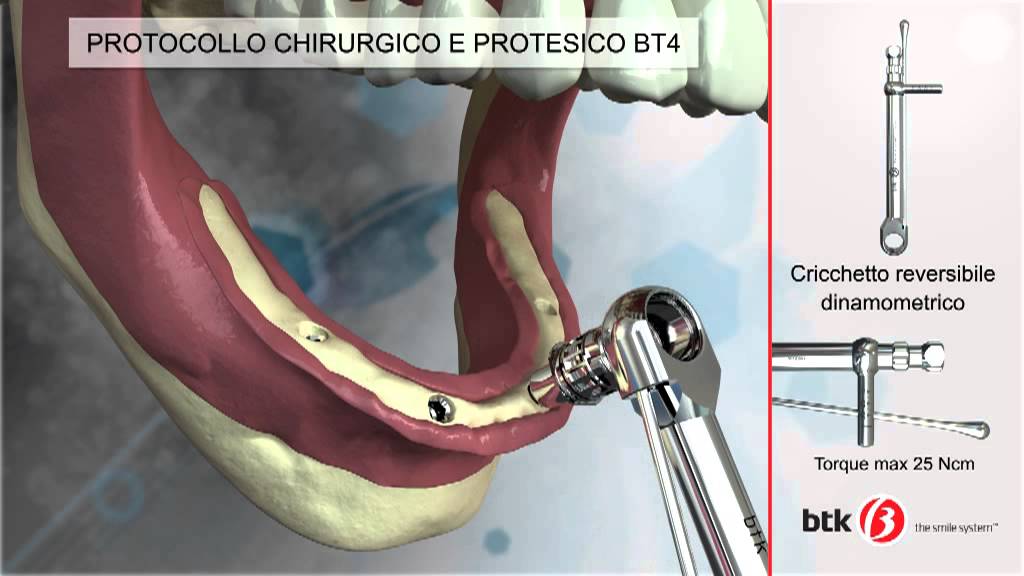BTK The Smile System - Protocollo chirurgico Protesica BT-4