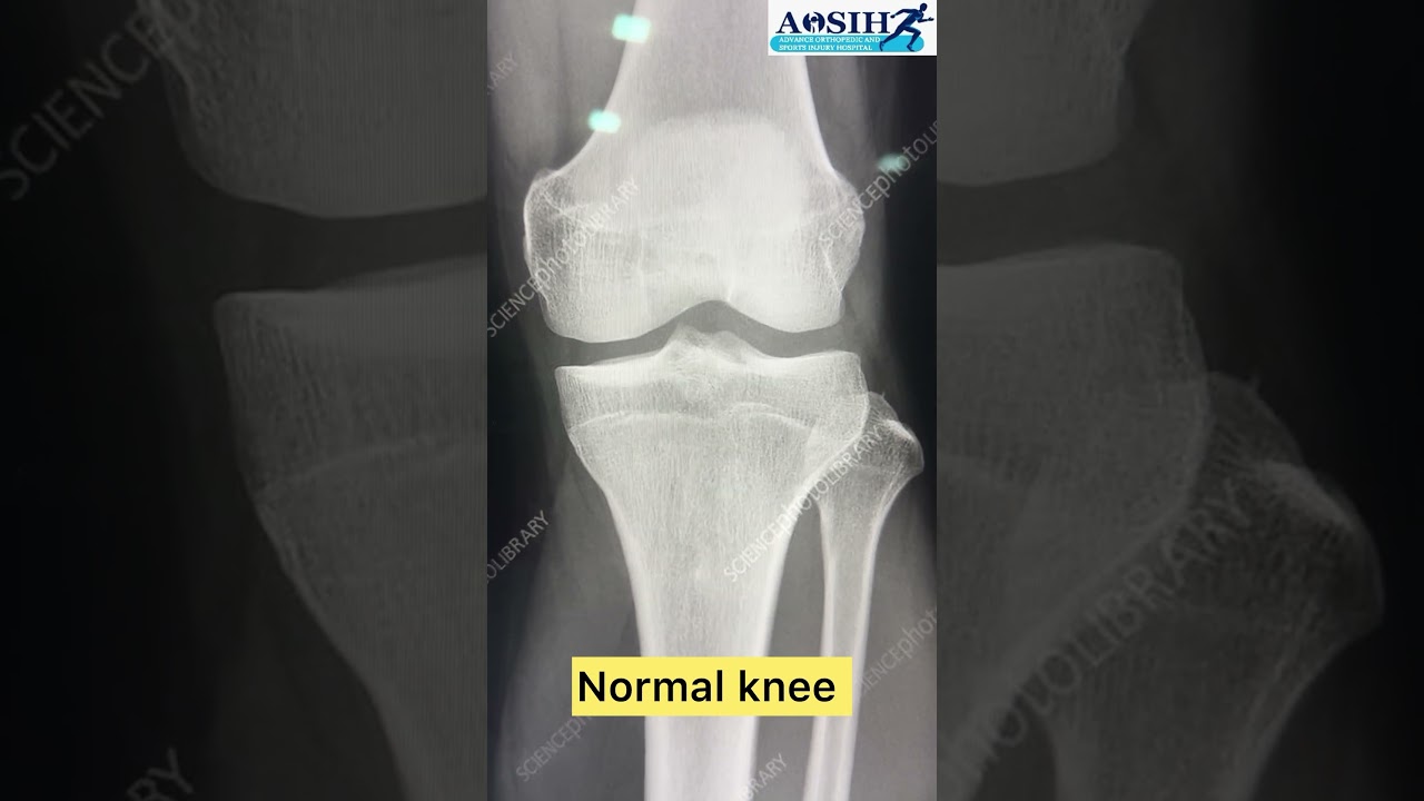 Knee X-ray ko kaise pahchane ki sahee hai ya nahee !!!