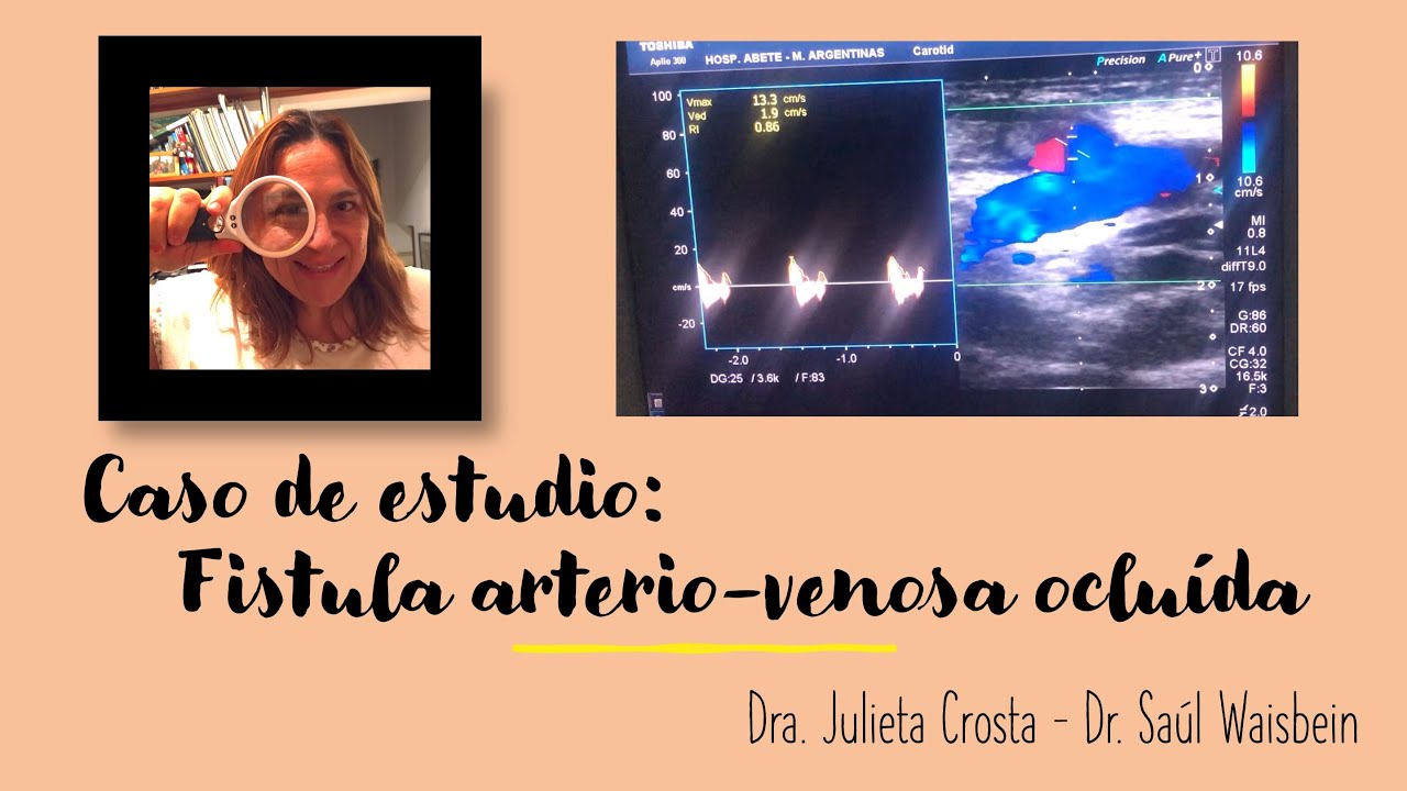 Caso Fístula arterio-venosa de hemodiálisis ocluída