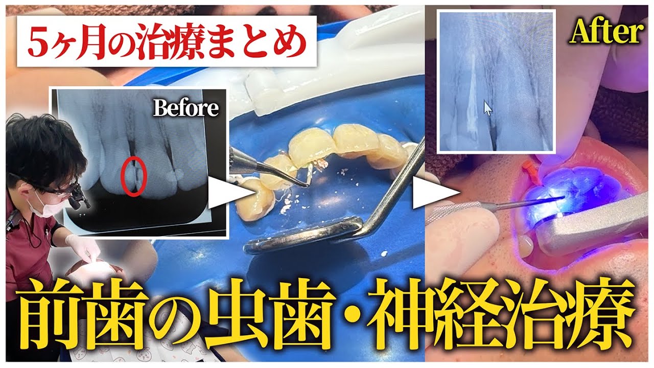 気づかないうちに大きな虫歯に&hellip;前歯の虫歯・神経治療に密着！まとめ編【ワイズ歯科矯正歯科＋KIDSイオン小牧店】