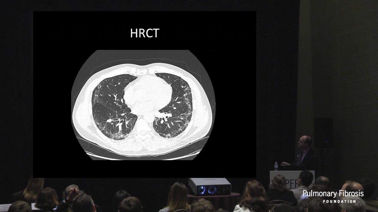 MDD and an Accurate Diagnosis in ILD | David Lederer, MD