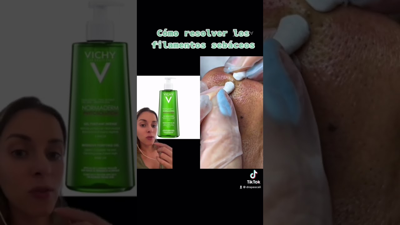 C&oacute;mo resolver los filamentos seb&aacute;ceos #filamentossebaceos