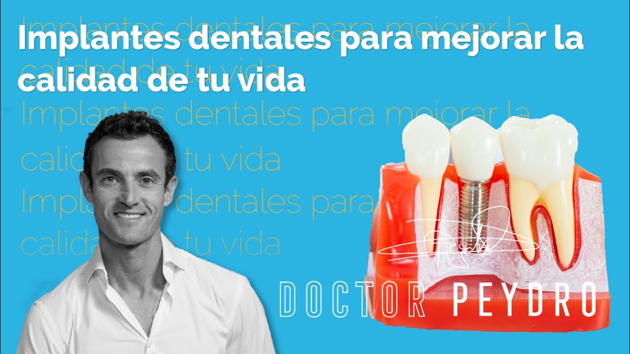 Cómo mejorar tu vida a través de IMPLANTES DENTALES