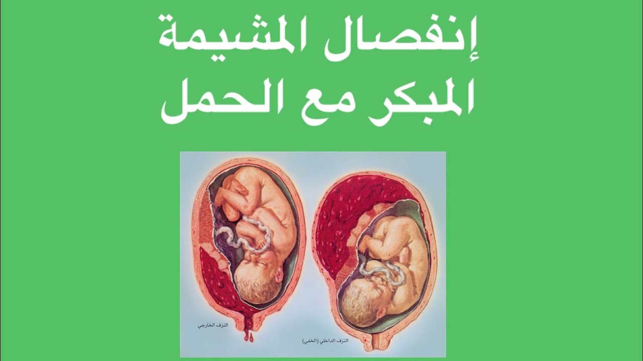 اسباب انفصال المشيمة مع الحمل وكيفية تجنبه