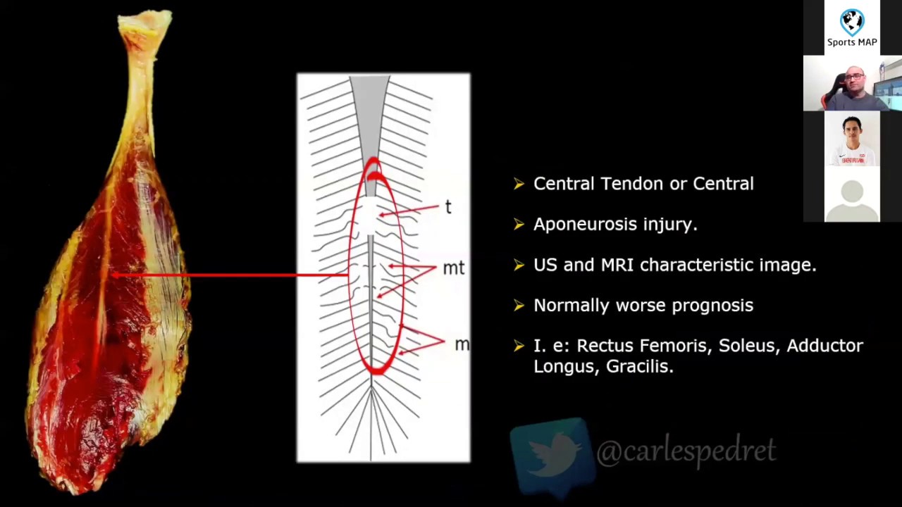 Carles Pedret: Anatomy of Muscle Injuries: The Utility of Imaging Tests