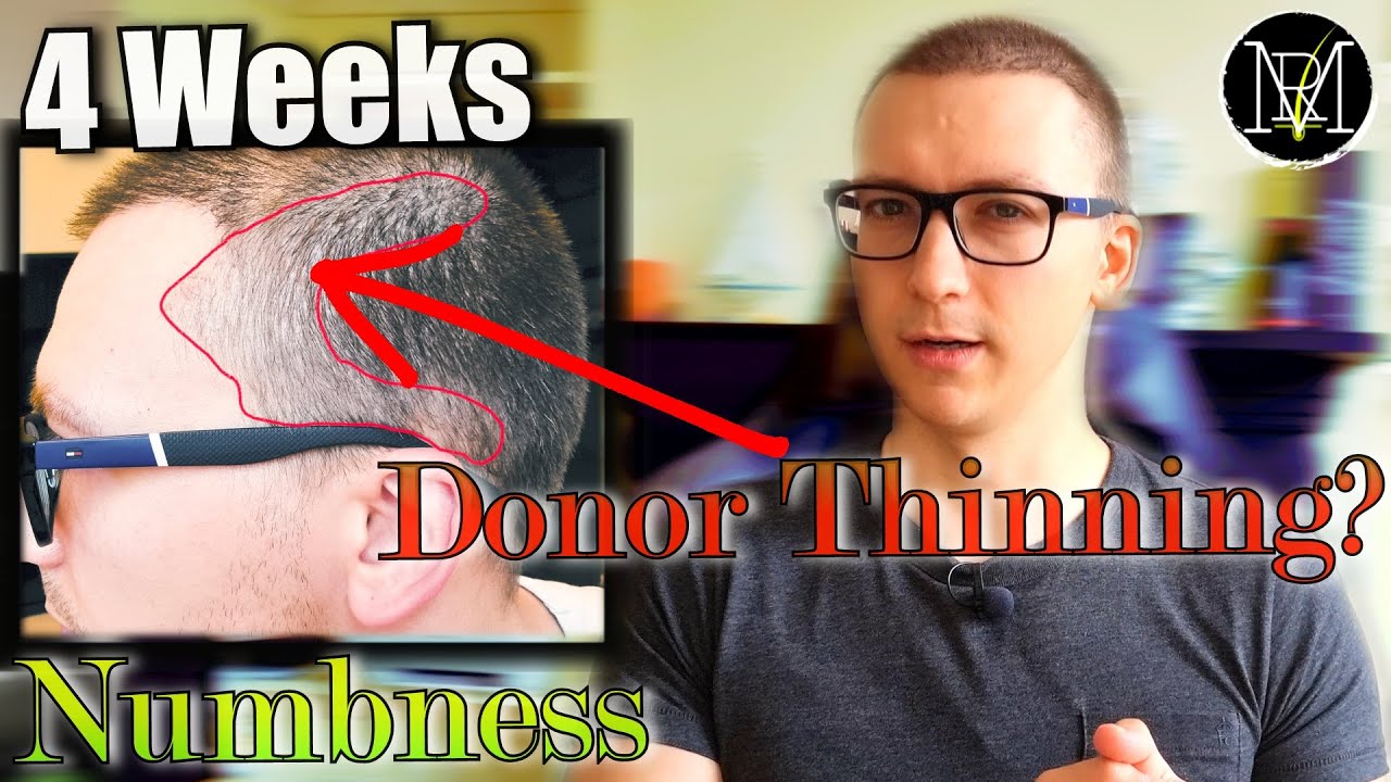 1 Month after 2nd FUE/DHI Hair Transplant. 6500 Grafts.