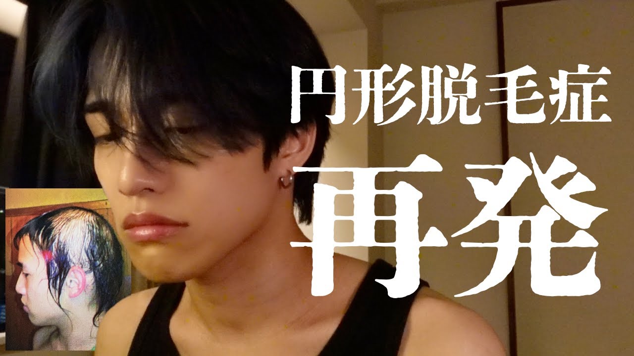 円形脱毛症が再発しちゃいました。