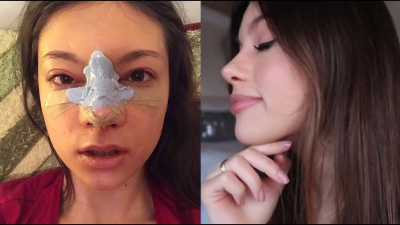 Burun Ameliyatım👃 Ağrı/Morluk Oldu Mu? Ödemlerimi Nasıl Attım? Fotoğraf ve Videolu İyileşme Sürecim