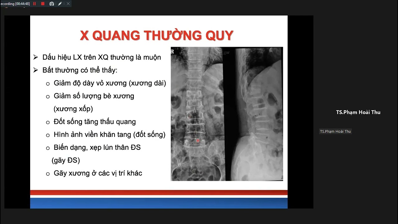 Cập nhật chẩn đoán và điều trị loãng xương