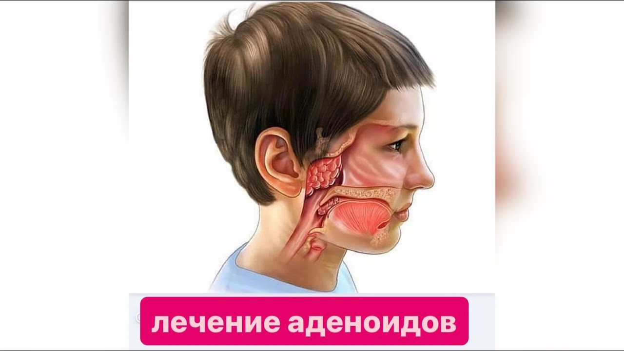 Аденоиды у детей. Лечение аденоидов без операции.