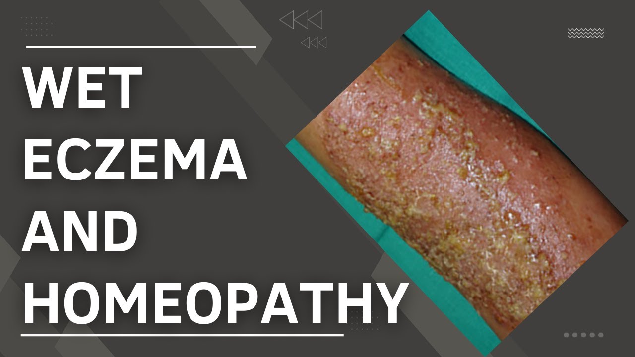 wet eczema and homeopathic treatment || best homeopathic medicine for wet eczema !