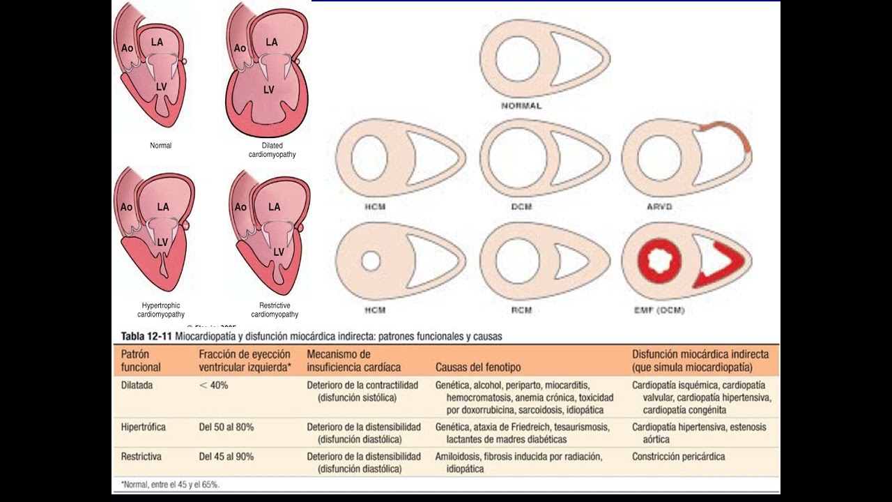 Miocardiopat&iacute;as - Patologia 2 Fmed