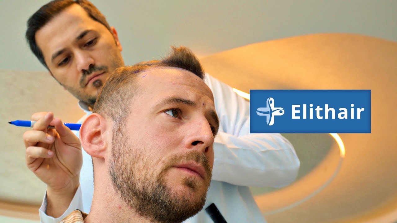 Meine Haartransplantation bei:  Dr. Balwi - Elithair