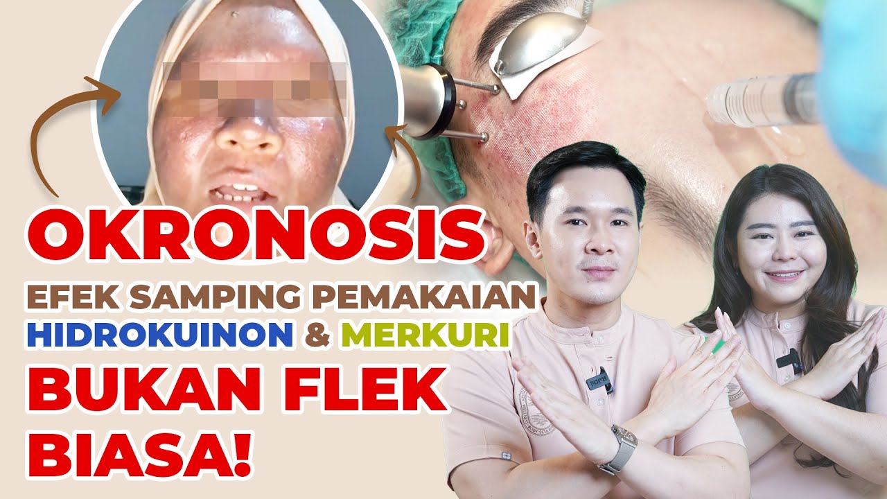 OKRONOSIS - EFEK SAMPING PEMAKAIAN HIDROKUINON & MERKURI. BEDA DENGAN FLEK BIASA!