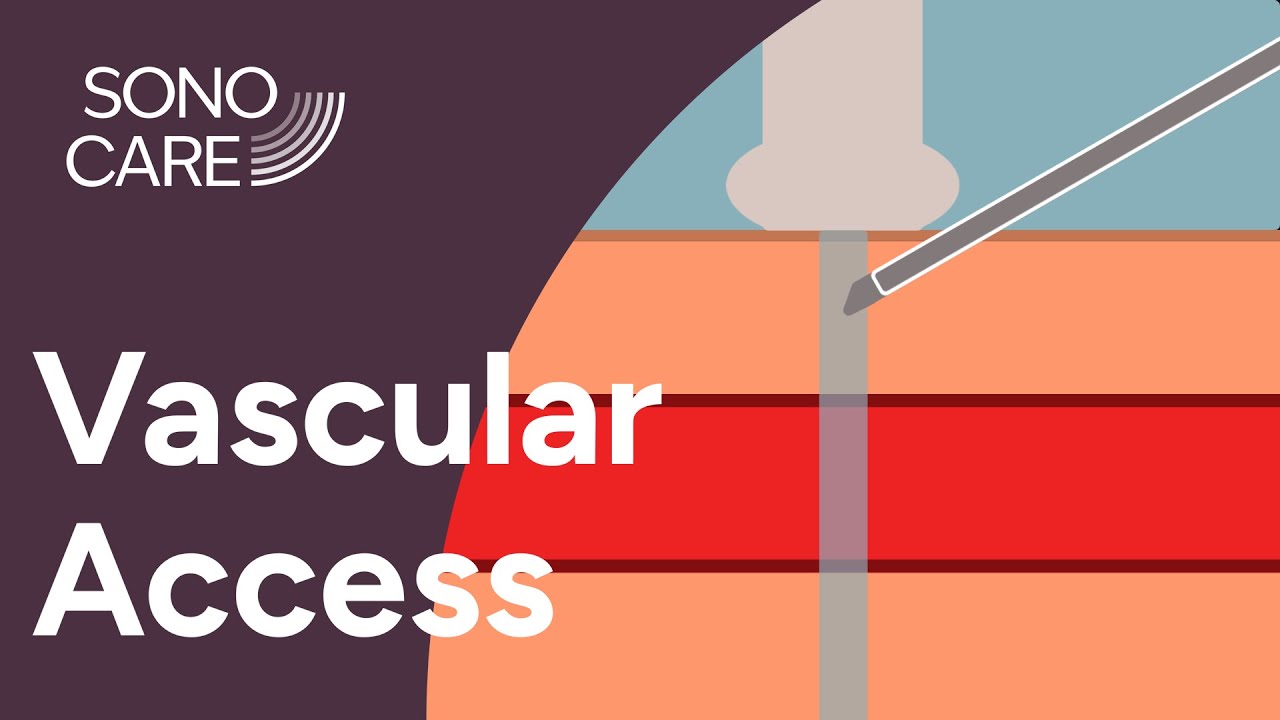 Vascular Access - Following Your Needle Tip