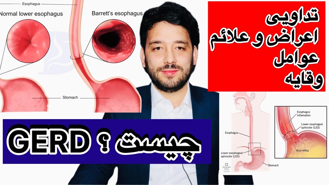 ریفلاکس معده (GERD) چیست؟ | علائم، علت‌ها، تشخیص و درمان کامل #shorts #gerd