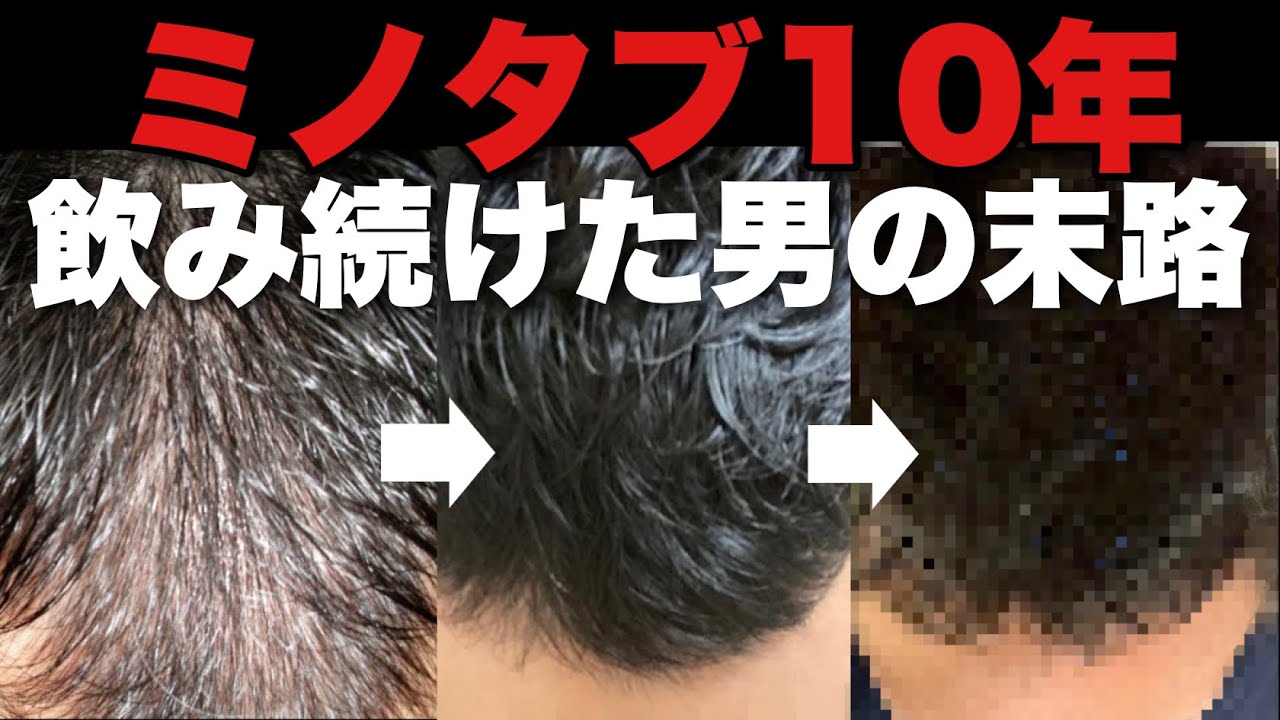 AGA治療 M字ハゲにミノタブ10㎎を10年間使い続けた効果と副作用