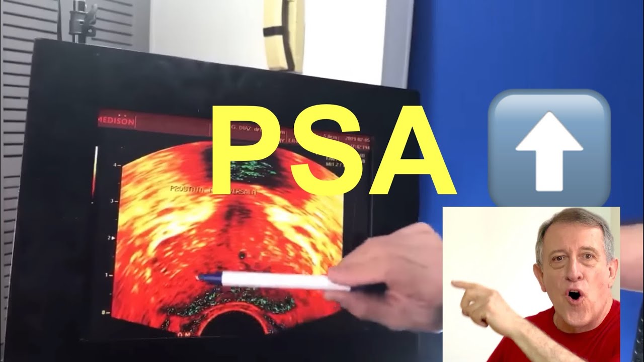 Operaron su próstata y su PSA esta alto