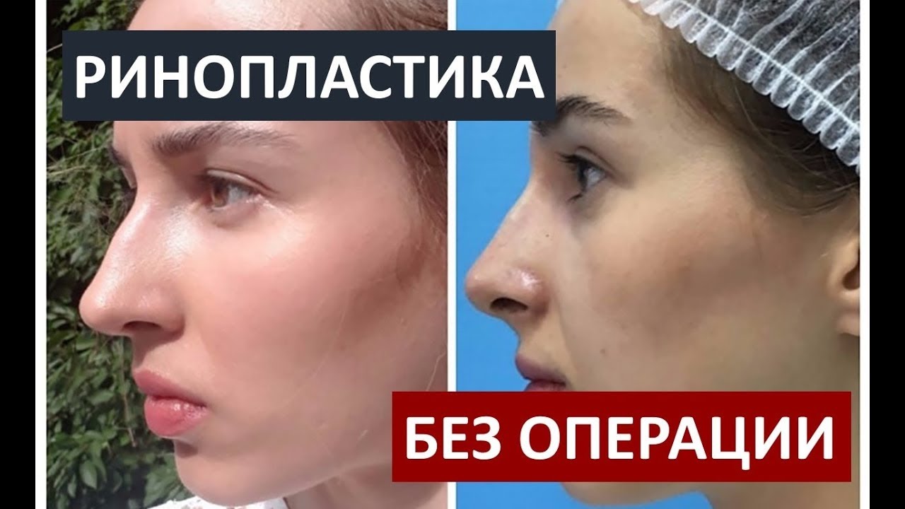 Безоперационная РИНОПЛАСТИКА препаратом Radiesse