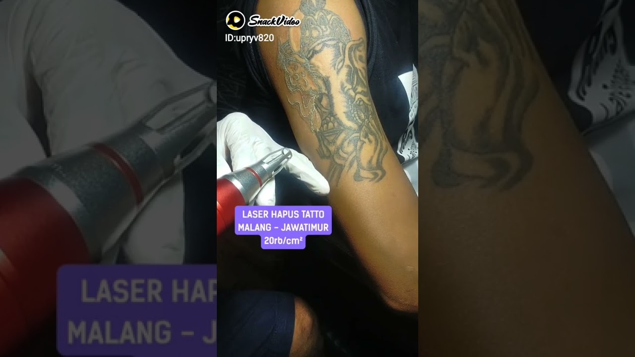 HAPUS TATTO AMAN TANPA MERUSAK KULIT, MURAH, ALAT STANDART KLINIK