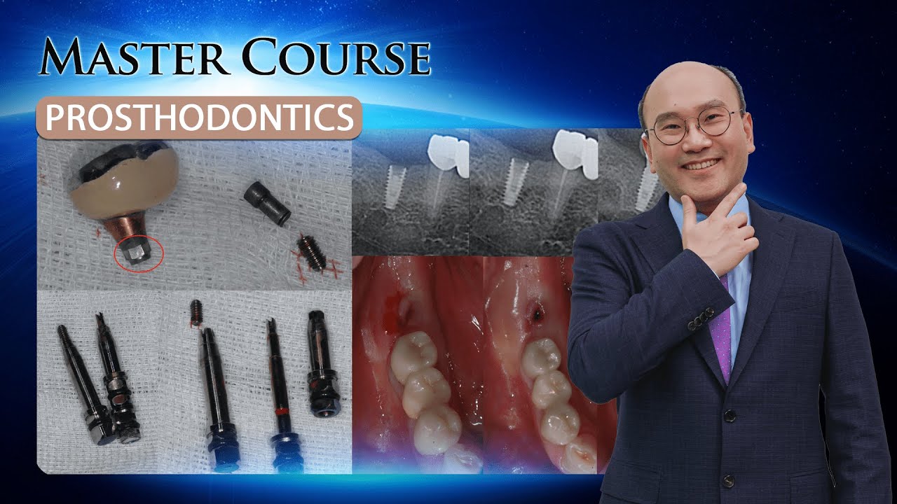 [Master Course - PROSTHODONTICS] Clinical Consideration of Screw loosening & Fracture