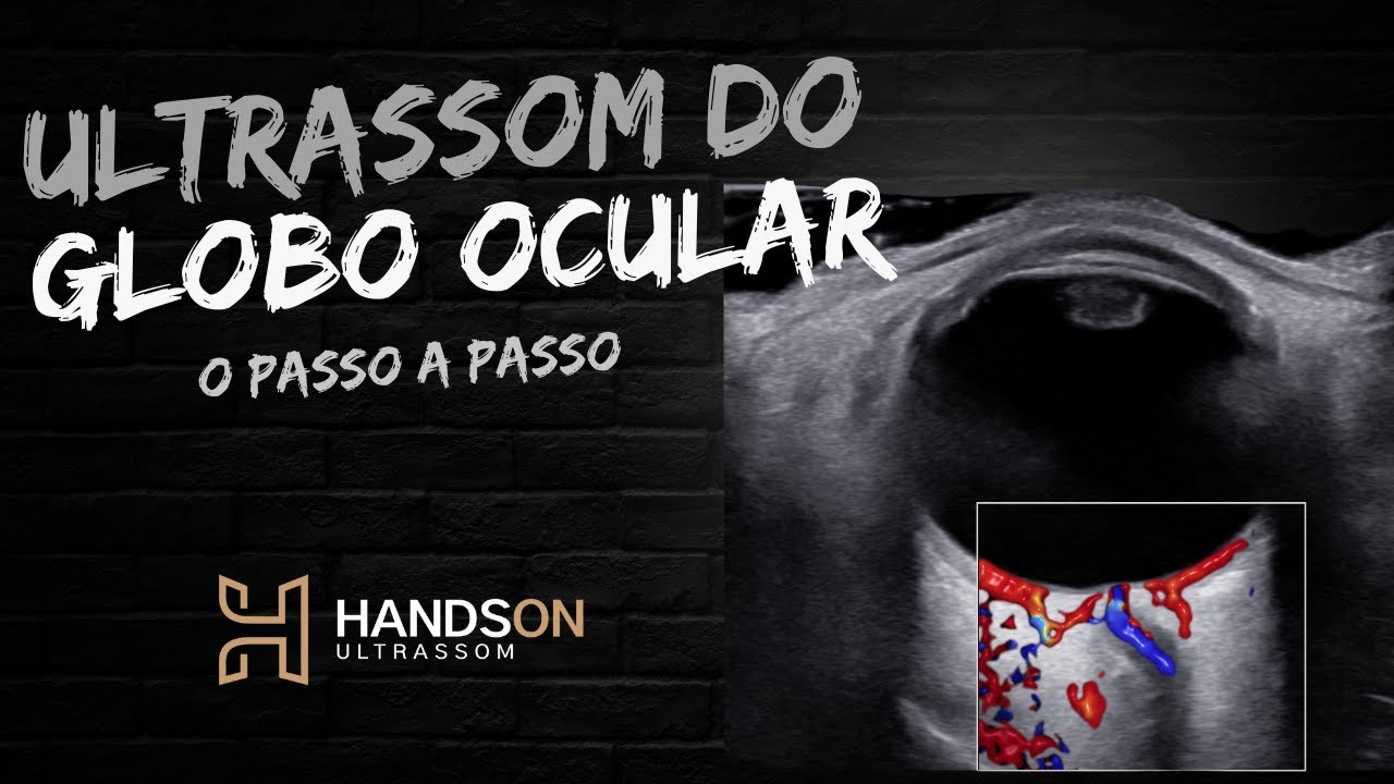 Ultrassonografia ocular - Oftalmológico / HandsOn Ultrassom / Michel Palheta