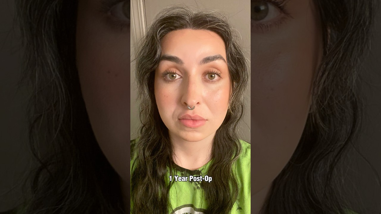 1 Year Post Facial Feminization Surgery Transformation😍 #trending #transformation #trans #results