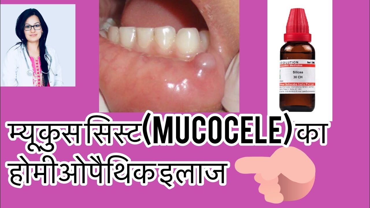 म्यूकुससिस्ट(Homeopathic treatment For mucocele)-Mucus cyst -Oral Cyst -Homeopathy-By डॉक्टर रुक्मणी