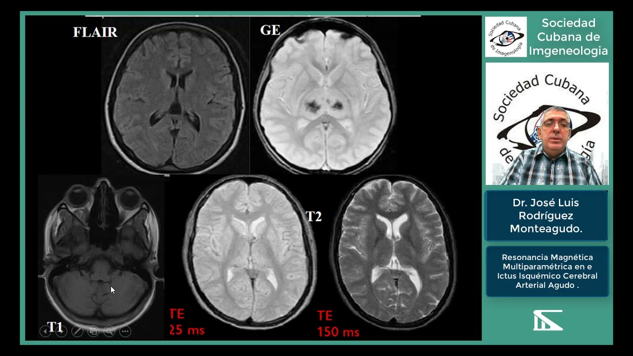 Resonancia magnética multiparamétrica en el ictus isquémico arterial agudo Dr José L Rodríguez