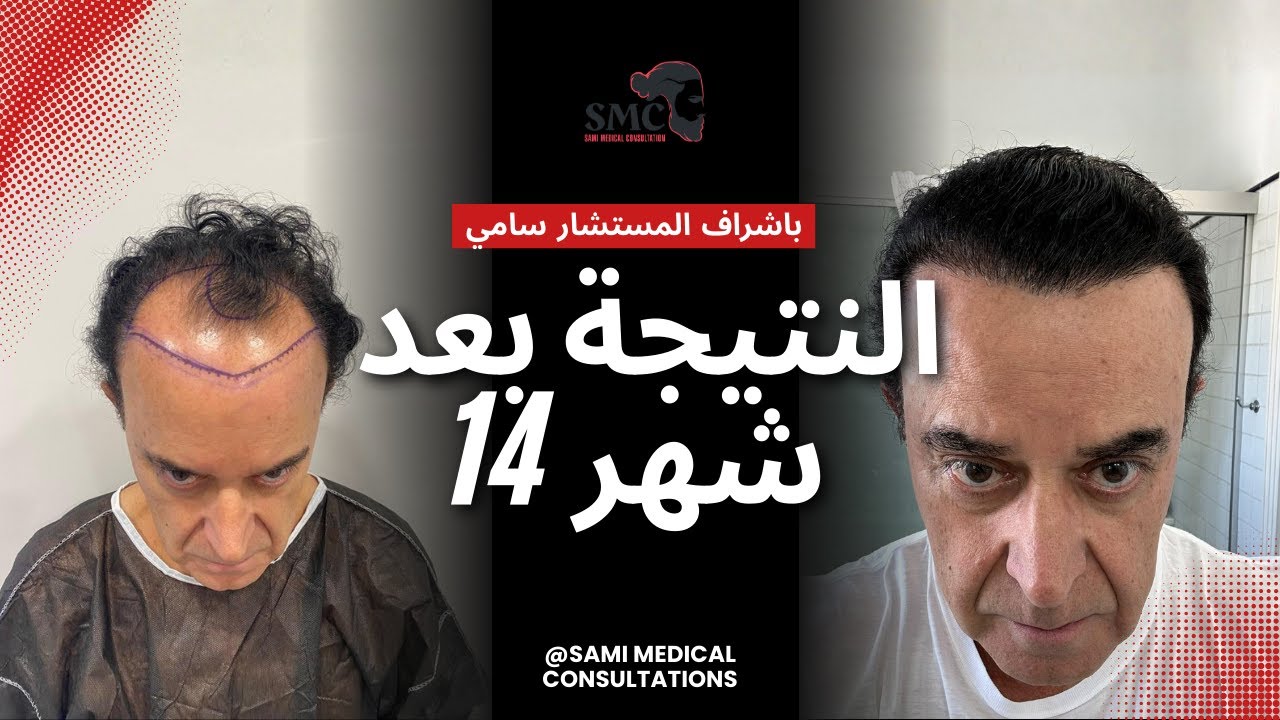 نتيجة زراعة الشعر بعد 14 شهر من العملية باشراف المستشار سامي