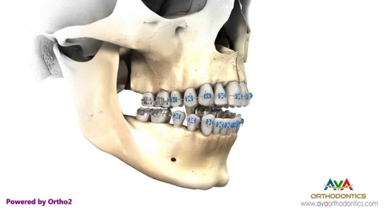 Surgical Orthodontic Treatment for Openbite - Maxillary Impaction