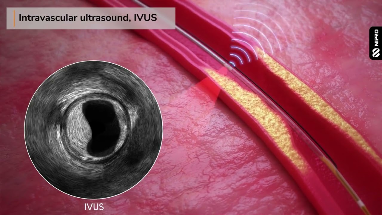 MK0062rA   IVUS + NIRS Animation HD 1080p