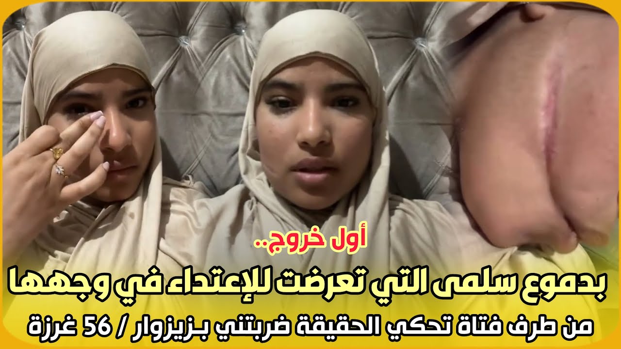 أول خروج..بدموع سلمى التي تعرضت للإعتداء في وجهها من طرف فتاة تحكي الحقيقة ضربتني بـزيزوار / 56 غرزة